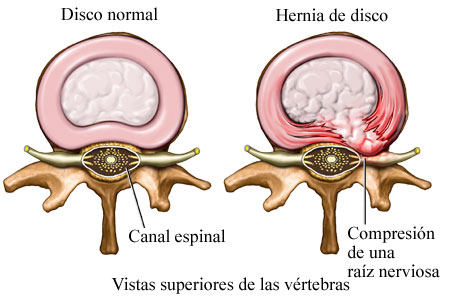 Hernia discal