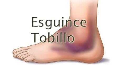 Esguince de tobillo