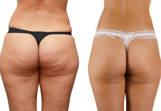 Qué es la celulitis y porque aparece