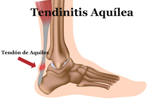 Tendinitis aquílea