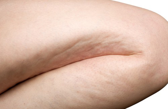 Combatir la celulitis