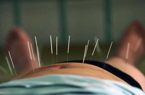 Adelgazar con acupuntura