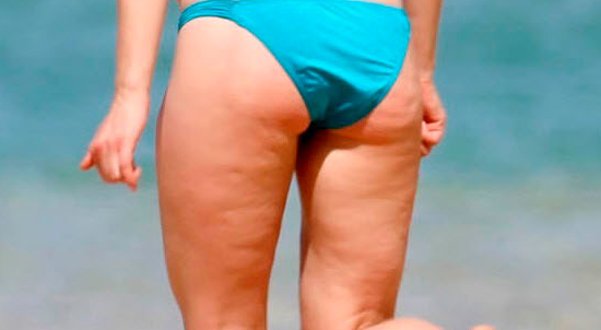Cuáles son los 4 tipos de celulitis que existen