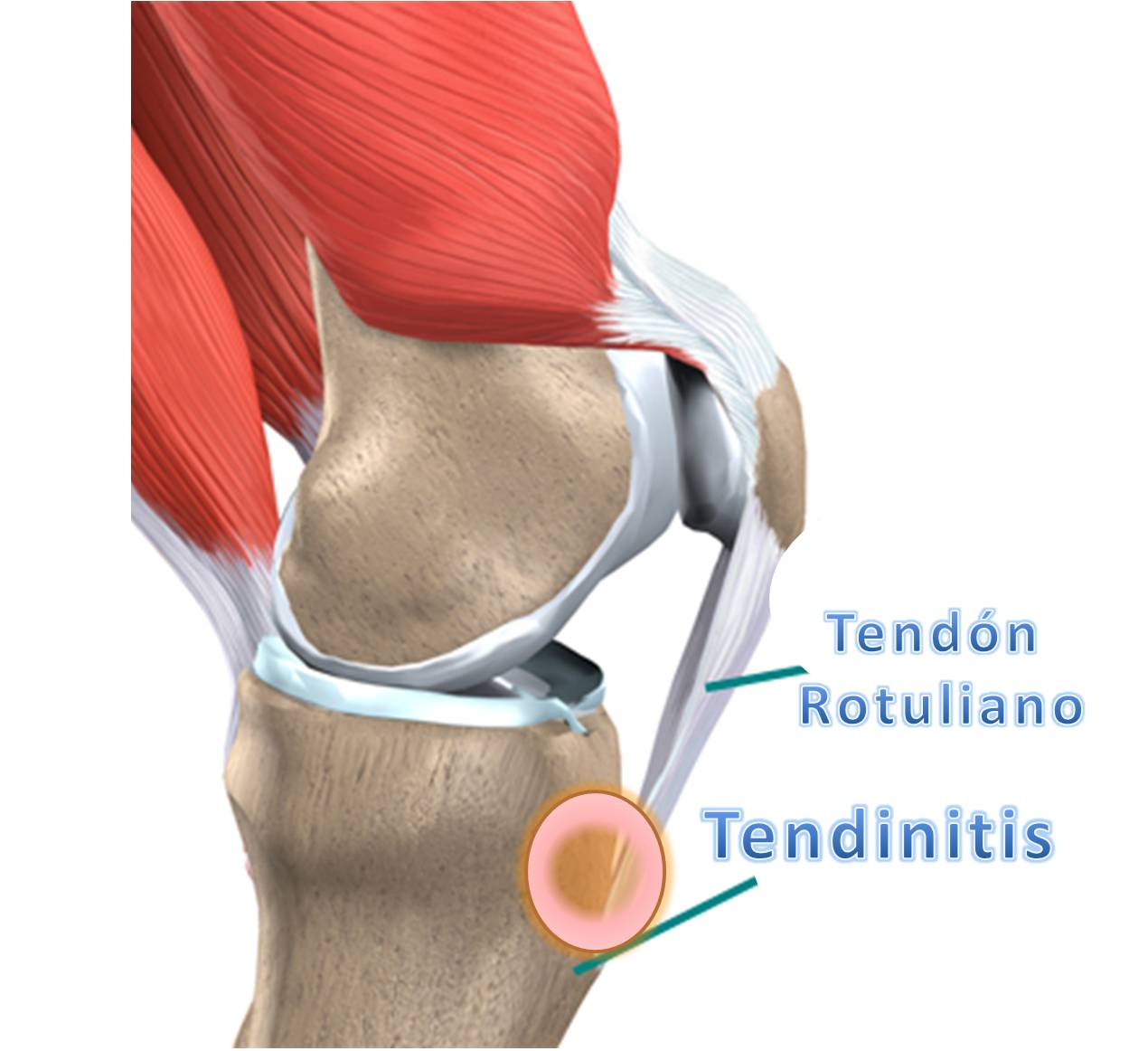 Todos los secretos de la tendinitis de rodilla