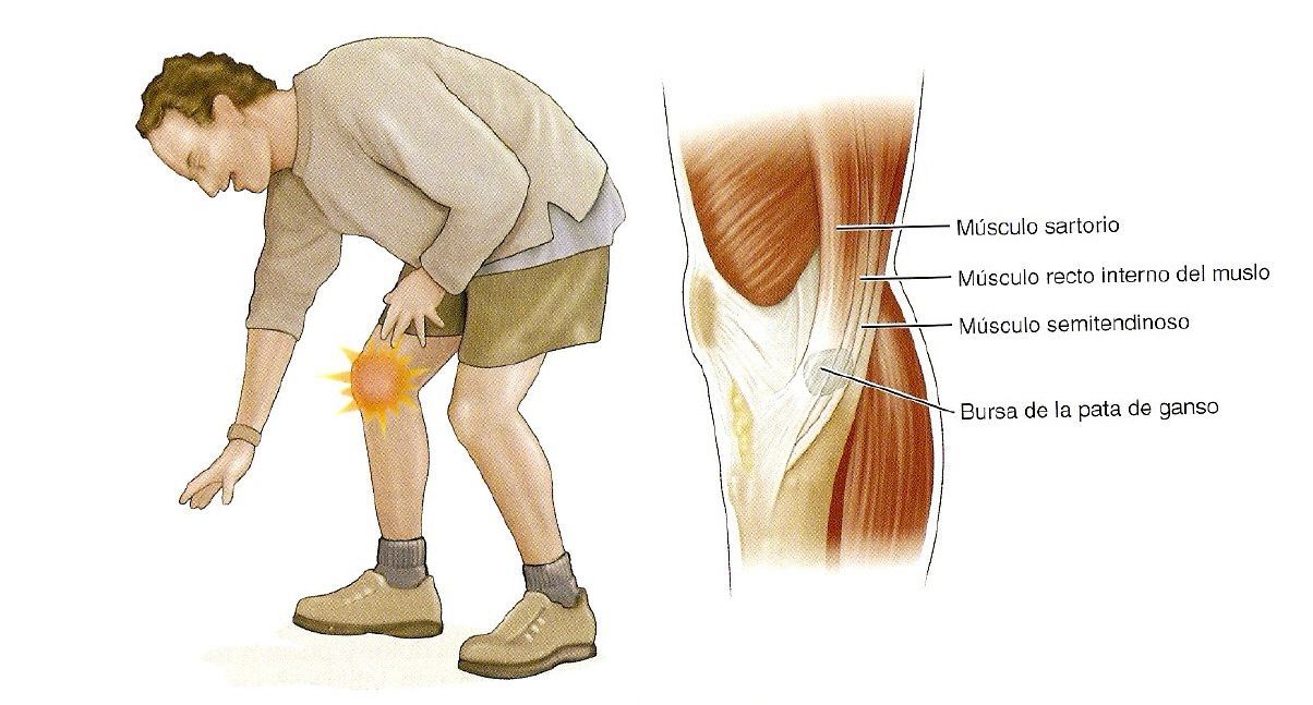 Todos los secretos de la tendinitis de rodilla