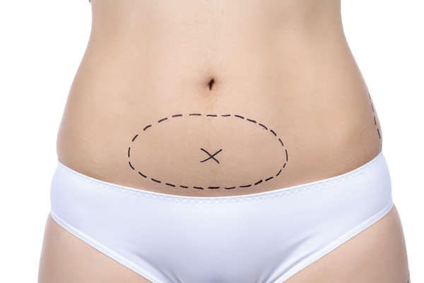 ¿Cómo eliminar grasa localizada en abdomen?