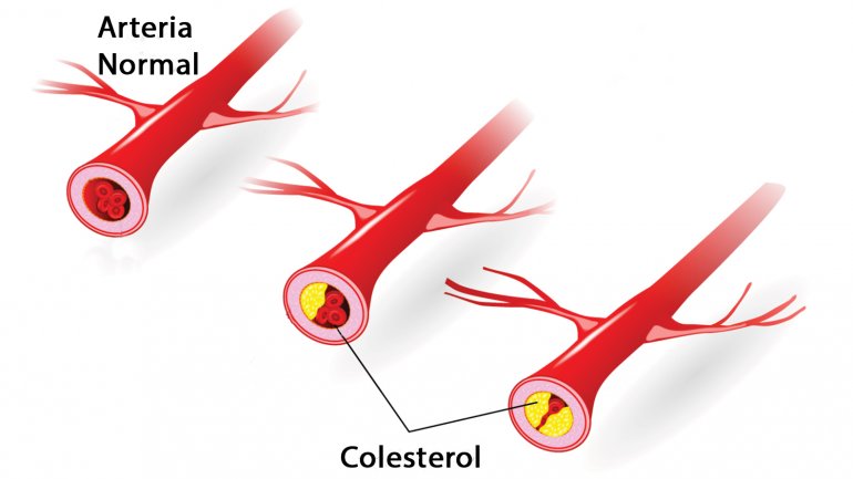 reducir el colesterol