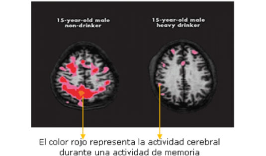 Daños del alcohol al cerebro ¿Cuáles son